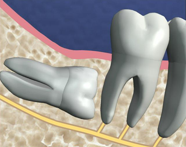 Extraction des dents de sagesse Chirurgiens-Dentistes Combs la Ville